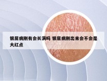 银屑病刚有会长满吗 银屑病刚出来会不会是大红点