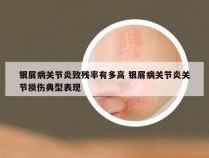 银屑病关节炎致残率有多高 银屑病关节炎关节损伤典型表现