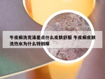 牛皮癣洗完澡差点什么皮肤舒服 牛皮癣皮肤洗热水为什么特别痒