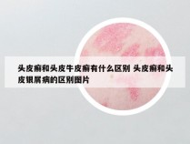 头皮癣和头皮牛皮癣有什么区别 头皮癣和头皮银屑病的区别图片