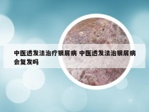 中医透发法治疗银屑病 中医透发法治银屑病会复发吗