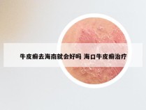 牛皮癣去海南就会好吗 海口牛皮癣治疗
