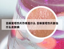 百癣夏塔热片作用是什么 百癣夏塔热片都治什么皮肤病