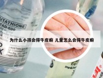 为什么小孩会得牛皮癣 儿童怎么会得牛皮癣