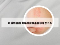 血燥银屑病 血燥银屑病手脚冰凉怎么办
