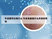 牛皮癣可以用什么 牛皮有癣用什么药膏好得快