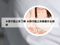 小孩子腿上长了癣 小孩子腿上长癣是什么症状