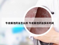 牛皮癣泡药浴怎么样 牛皮癣泡药浴多长时间