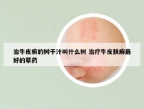 治牛皮癣的树干汁叫什么树 治疗牛皮肤癣最好的草药