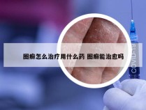 圈癣怎么治疗用什么药 圈癣能治愈吗