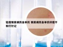 轻度银屑病苏金单抗 银屑病苏金单抗印度干粉打针记