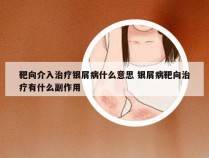 靶向介入治疗银屑病什么意思 银屑病靶向治疗有什么副作用