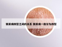 银屑病四型之间的关系 银屑病一般分为四型