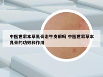 中医世家本草乳膏治牛皮癣吗 中医世家草本乳膏的功效和作用