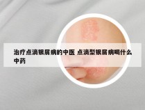 治疗点滴银屑病的中医 点滴型银屑病喝什么中药
