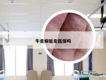 牛皮癣能走医保吗