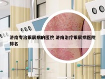 济南专治银屑病的医院 济南治疗银屑病医院排名