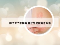 脖子生了牛皮癣 脖子牛皮肤癣怎么治