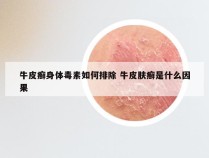 牛皮癣身体毒素如何排除 牛皮肤癣是什么因果