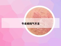 牛皮癣阳气不足