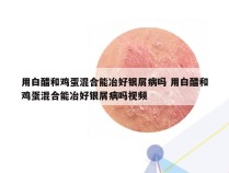 用白醋和鸡蛋混合能冶好银屑病吗 用白醋和鸡蛋混合能冶好银屑病吗视频