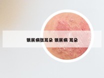 银屑病张耳朵 银屑病 耳朵