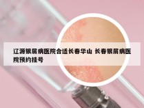 辽源银屑病医院合适长春华山 长春银屑病医院预约挂号