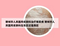 聊城市人民医院皮肤科治疗银屑病 聊城市人民医院皮肤科在东区还是西区