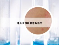 龟头长银屑病怎么治疗