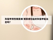 灰指甲阴性银屑病 银屑病引起的灰指甲能治愈吗?