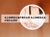 头上皮癣怎么治疗用什么药 头上皮癣怎么治疗用什么药好