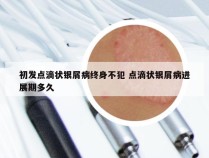 初发点滴状银屑病终身不犯 点滴状银屑病进展期多久