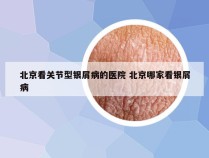 北京看关节型银屑病的医院 北京哪家看银屑病