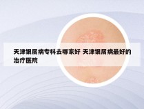 天津银屑病专科去哪家好 天津银屑病最好的治疗医院
