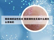 银屑病感染性皮炎 银屑病样皮炎是什么病怎么得来的