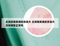 点滴状银屑病皮损变大 点滴银屑病皮损变大没有鳞屑正常吗