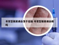 寻常型银屑病会发于后脑 寻常型银屑病会痒吗