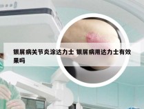 银屑病关节炎涂达力士 银屑病用达力士有效果吗