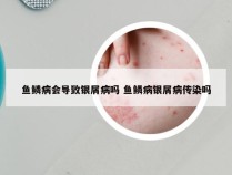 鱼鳞病会导致银屑病吗 鱼鳞病银屑病传染吗