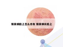 银屑病脸上怎么也有 银屑病长脸上
