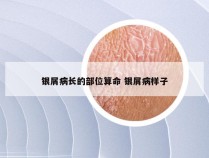 银屑病长的部位算命 银屑病样子