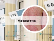 牛皮癣吃茴香行吗