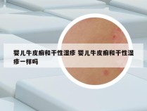 婴儿牛皮癣和干性湿疹 婴儿牛皮癣和干性湿疹一样吗