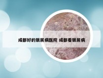 成都好的银屑病医院 成都看银屑病