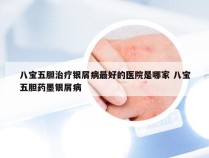 八宝五胆治疗银屑病最好的医院是哪家 八宝五胆药墨银屑病