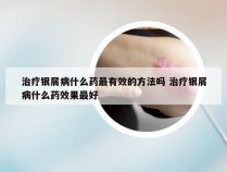 治疗银屑病什么药最有效的方法吗 治疗银屑病什么药效果最好