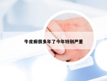 牛皮癣很多年了今年特别严重
