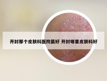开封那个皮肤科医院最好 开封哪里皮肤科好