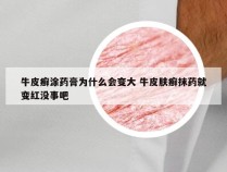 牛皮癣涂药膏为什么会变大 牛皮肤癣抹药就变红没事吧