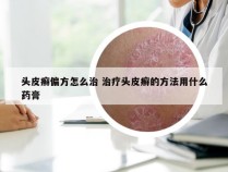 头皮癣偏方怎么治 治疗头皮癣的方法用什么药膏